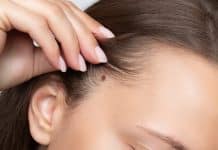 Staračke pjege: uzroci i zaštita staračke pjege