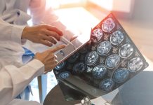 Multipla skleroza u brojkama: Hrvatska, EU i svijet