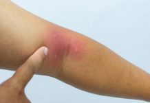 Ubodi kukaca – kada potražiti liječničku pomoć